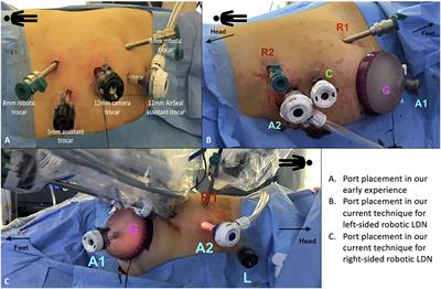 Robot-Assisted Laparoscopic Living Donor Nephrectomy: The University of Florence Technique